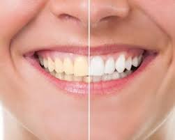 Smile Designing Treatment in Noida