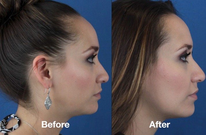 kybella