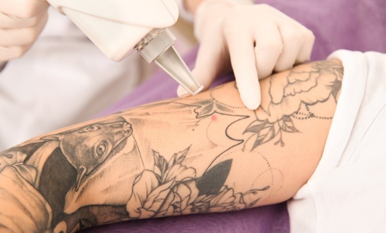 tattoo removal