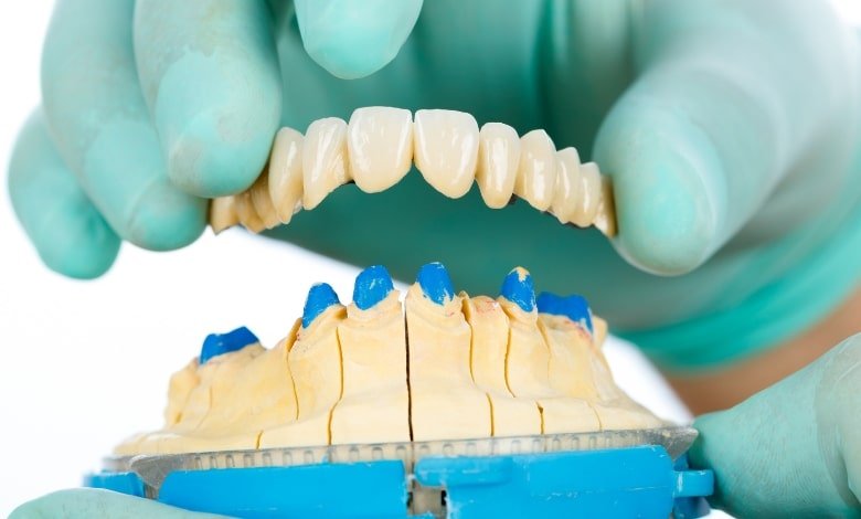 dental bridges
