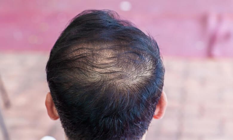 hair loss solutions