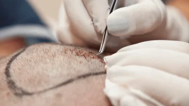 DHI hair transplant in Turkey