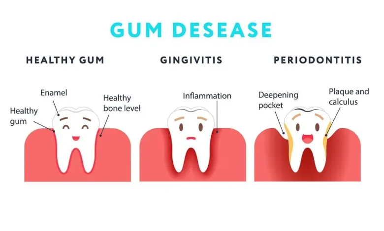 types of gum disease