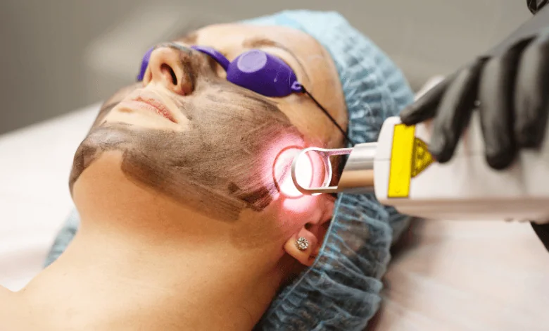 laser skin resurfacing